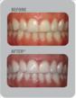 Before and After Whitening Results